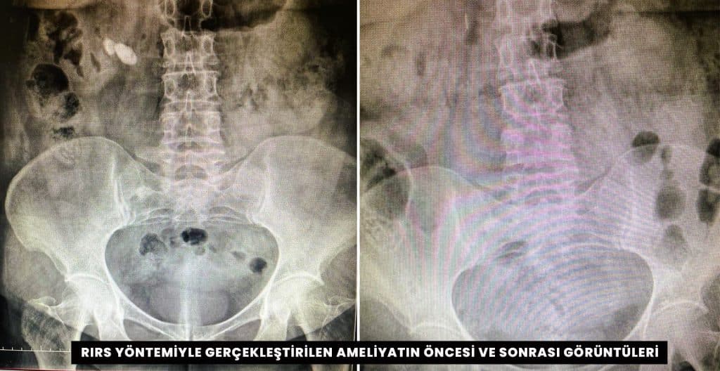 Havalar Isınırken, Böbrek Taşlarına Dikkat…